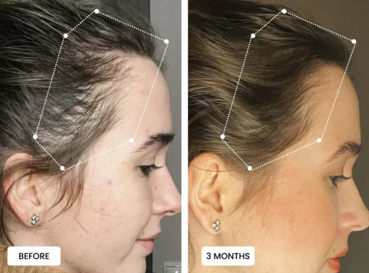 Before and after comparison showing visible hair growth and improved scalp health after 3 months of using the Scalp Trio massage